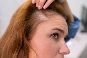 Αραίωση μαλλιών