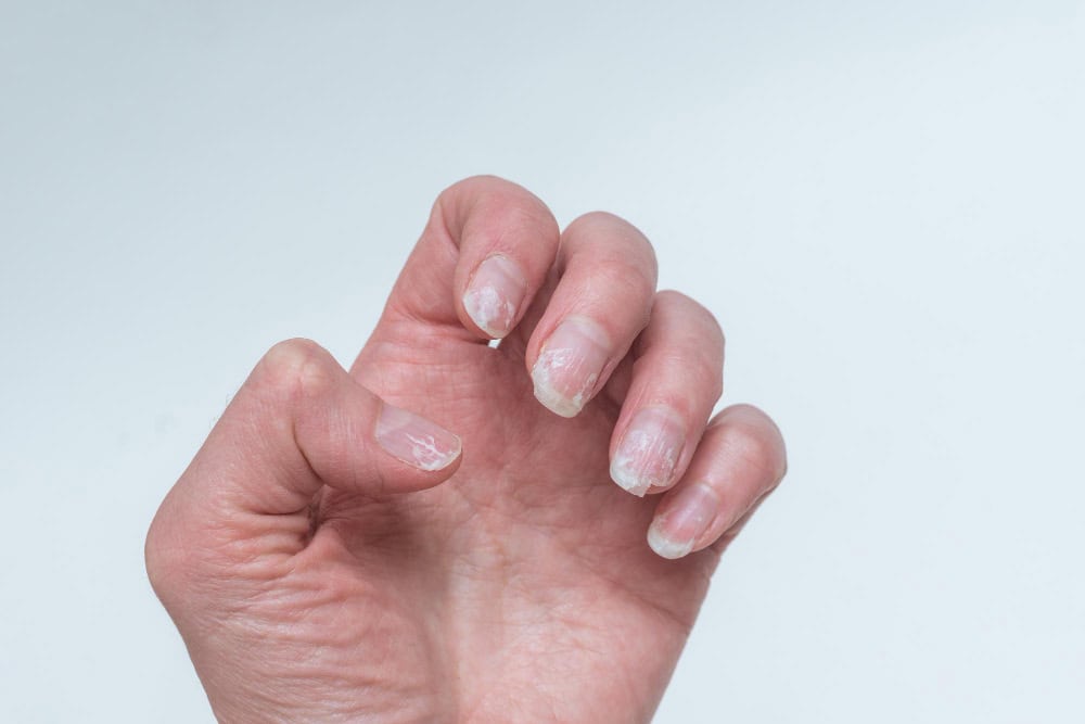 broken nails